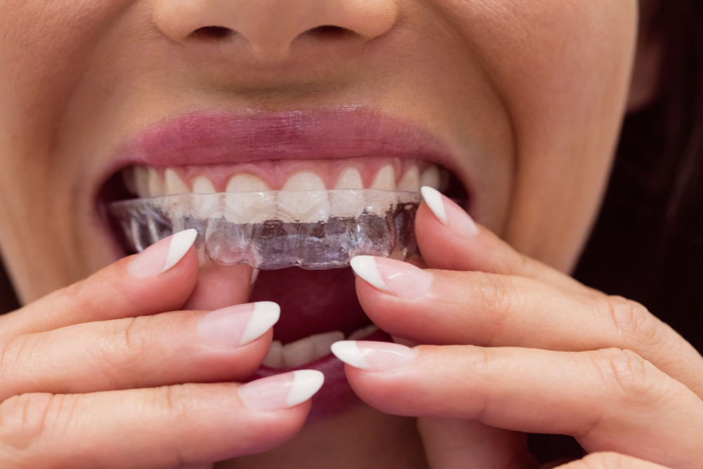 invisalign coquitlam