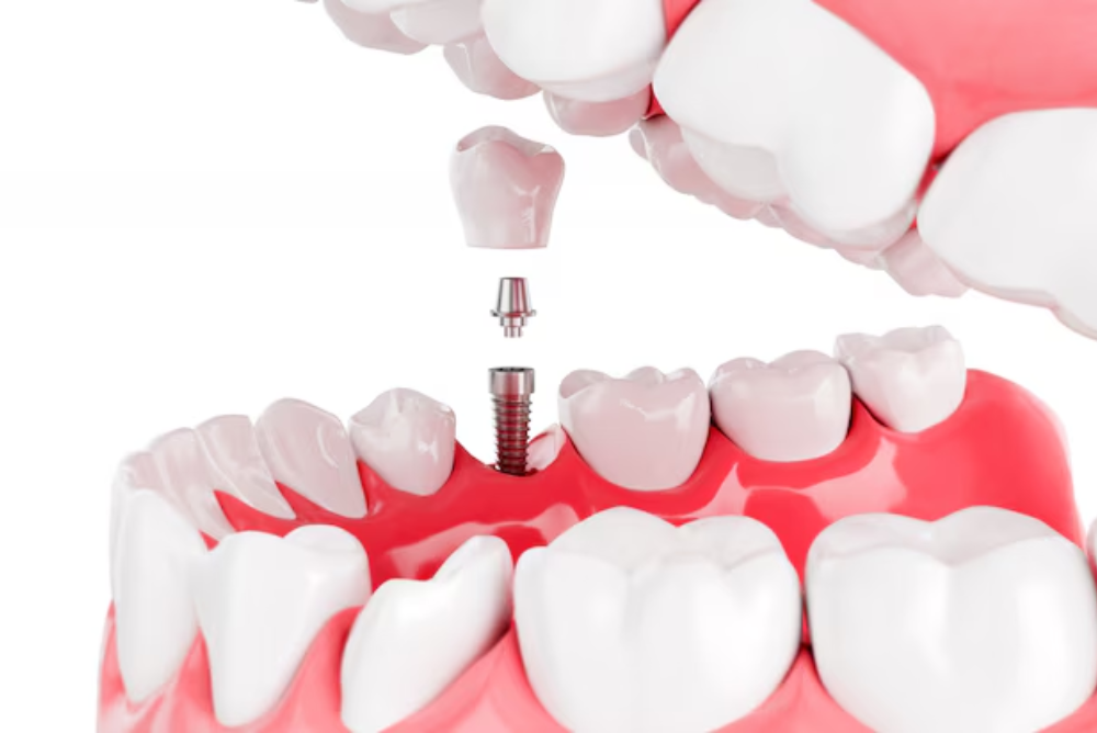 Dental Implants in Coquitlam