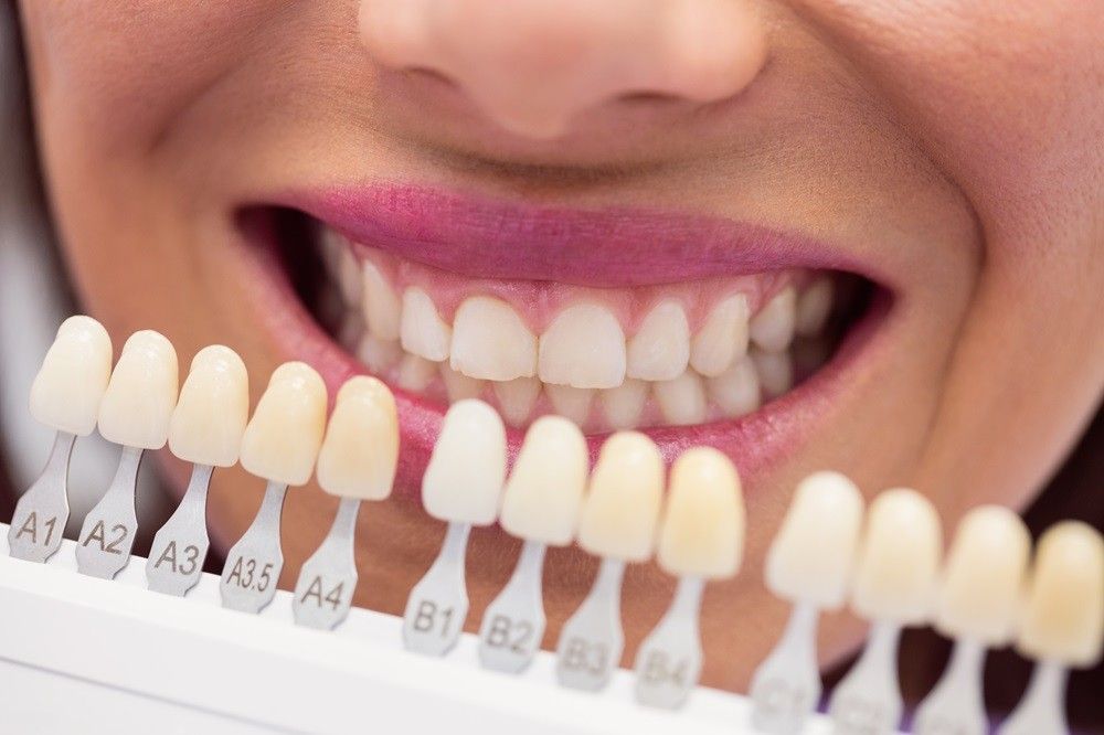 How Many Dental Veneers Do You Need for a Full Smile Makeover